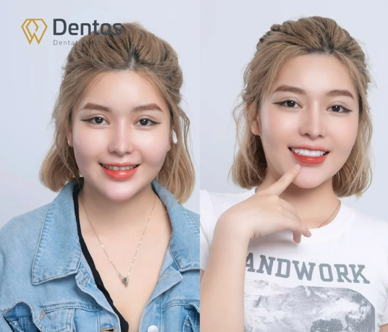 Răng sứ Zirconia trắng sáng tự nhiên, độ trong mờ cao và hiệu ứng chuyển màu tinh tế